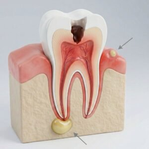 Dor de dente com pus: ilustração 3D de abscesso dentário na gengiva