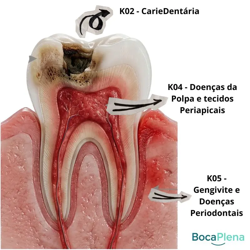 Infográfico mostrando as partes do dente e os códigos cid k02 para cárie, k04 para canal e k05 para gengiva